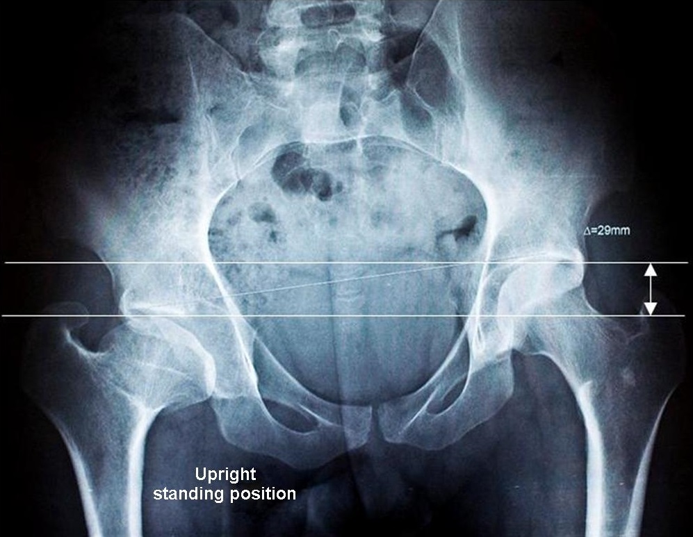 Radiography of the pelvis