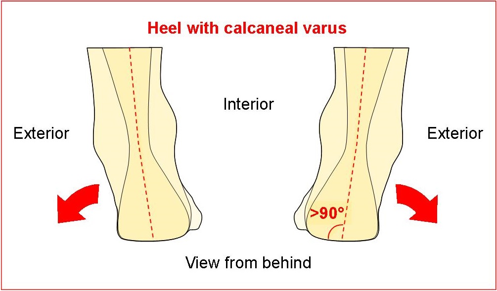Heel with calcaneal varus