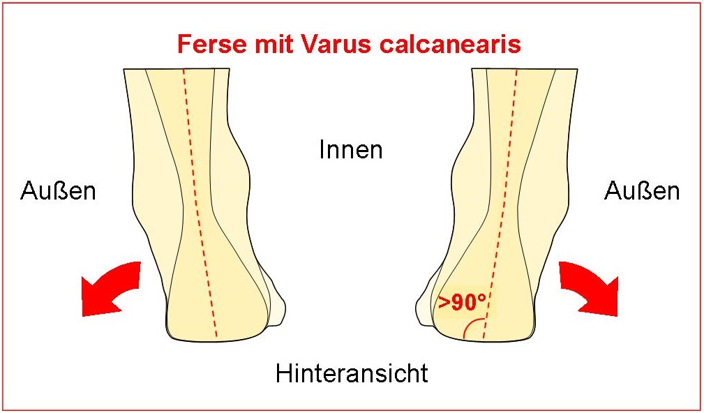 Schema Varus calcanearis