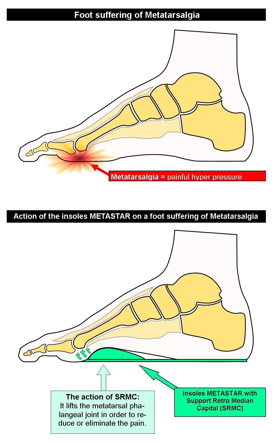 Hammer Toe