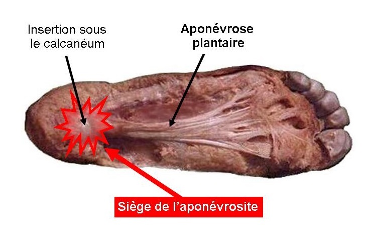 Aponévrosite plantaire