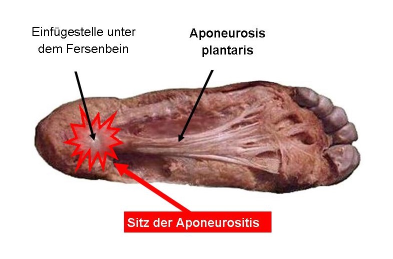 Aponeurositis