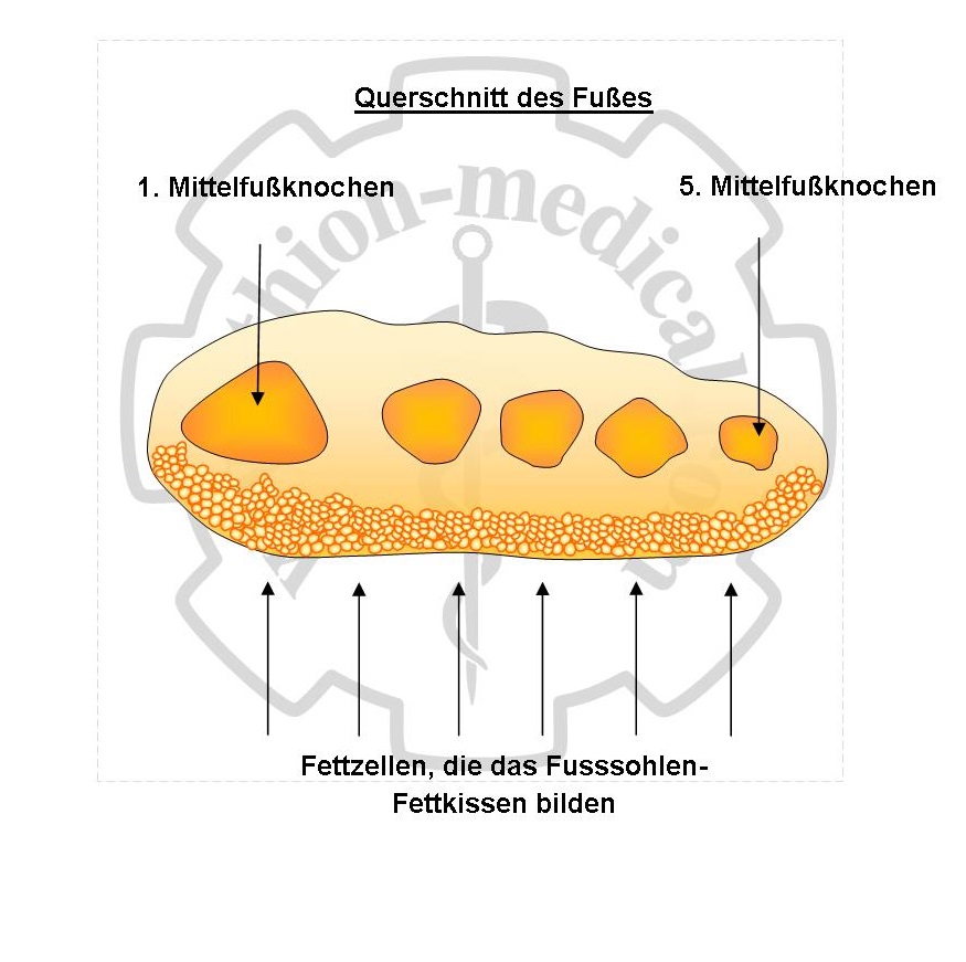 Fusssohlen-Fettkissens