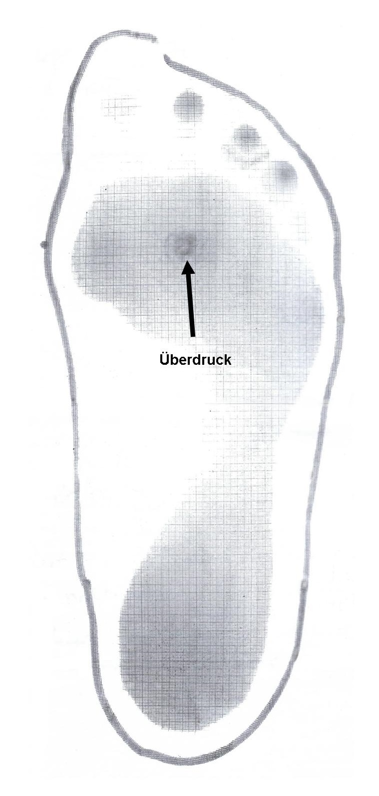 Fußsohlenabdruck mit Überdruck im Bereich des 2. Mittelfußknochenkopfes