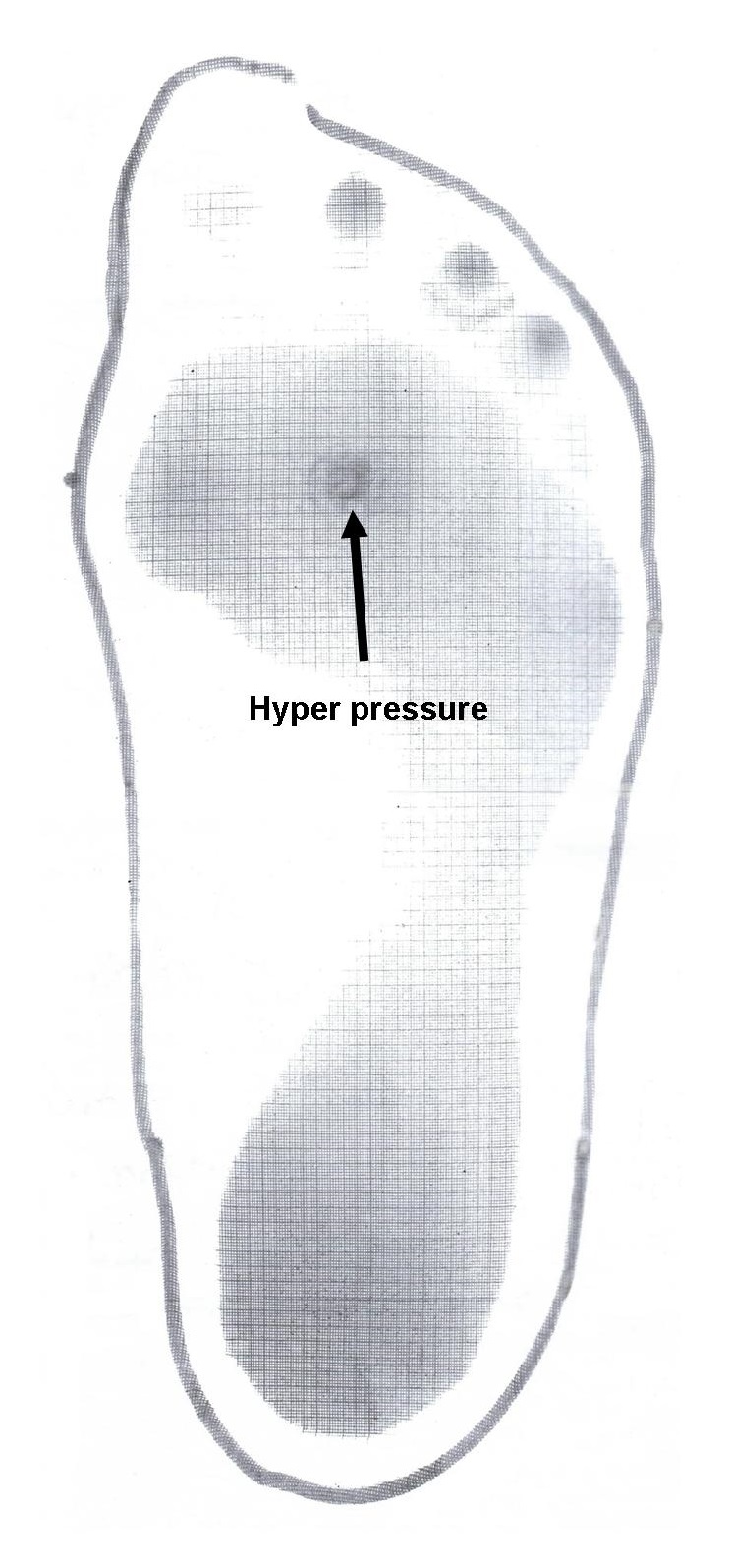 Plantar footprint with hyper pressure