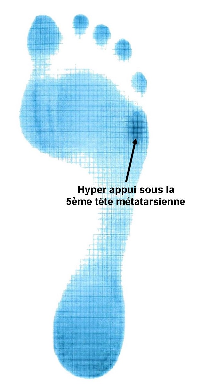 Empreinte de pied avec hyper appui sous la 5ème tête métatarsienne