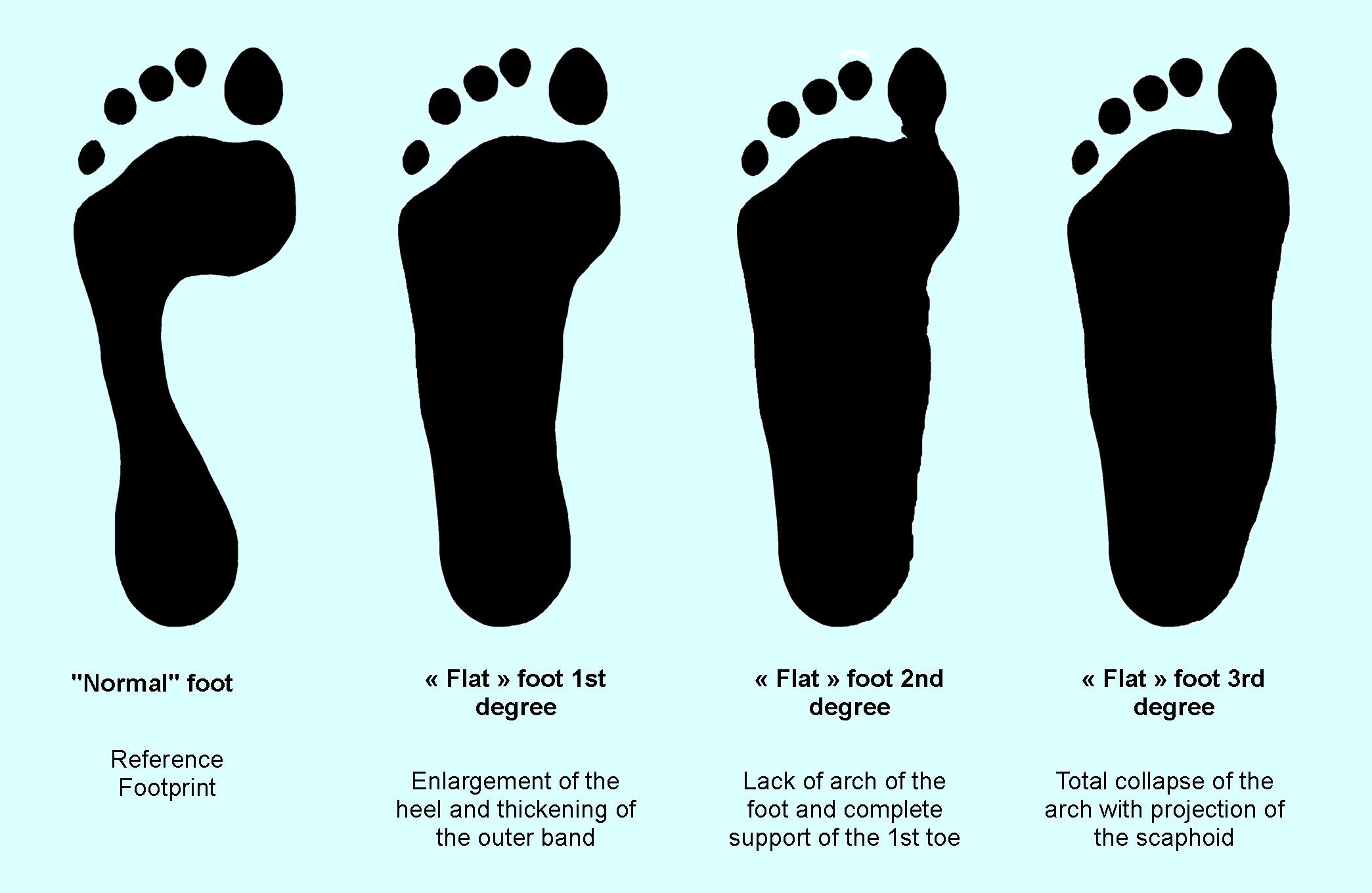 Footprint diagram of flat foot