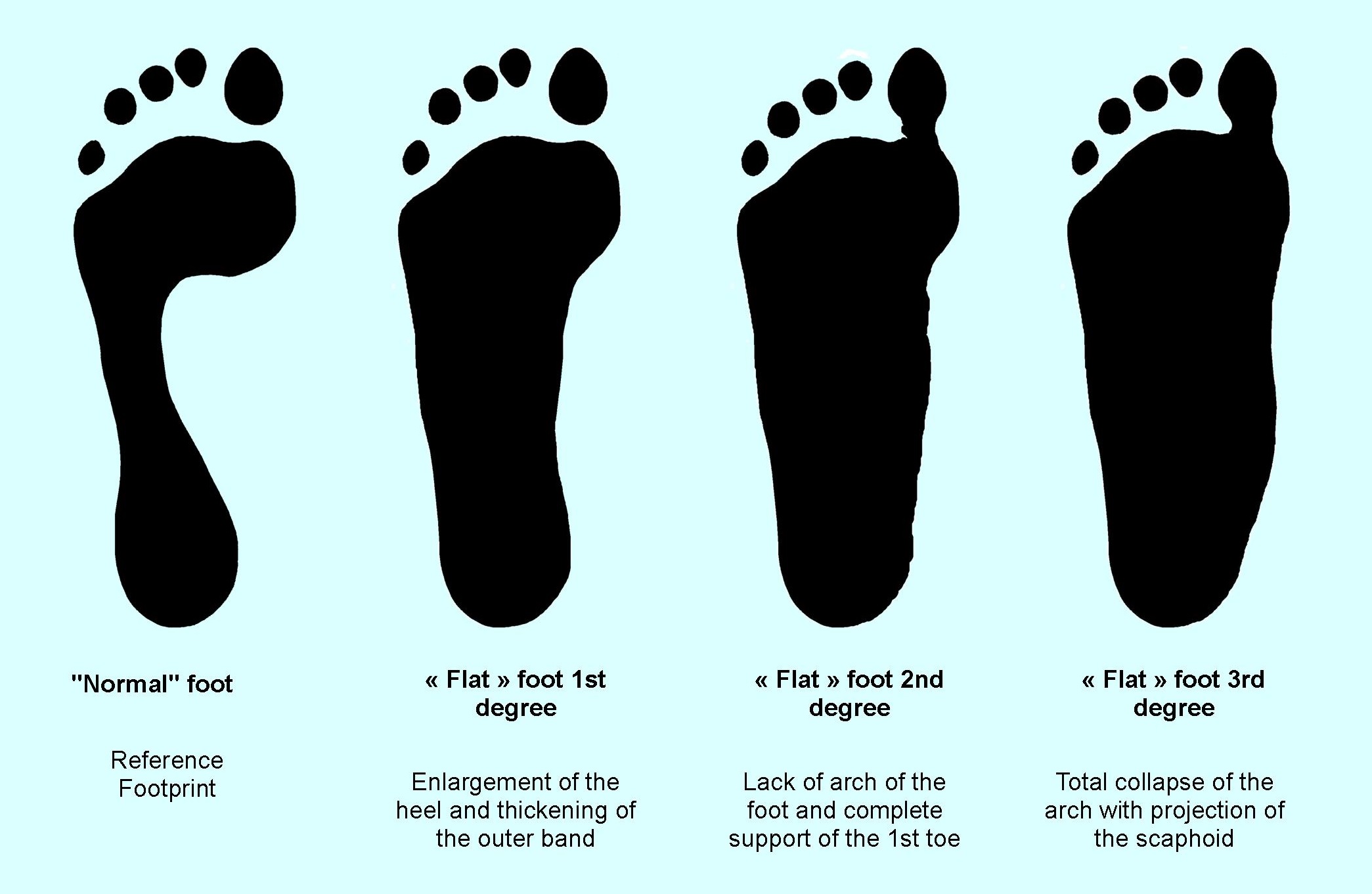 Supination Footprint