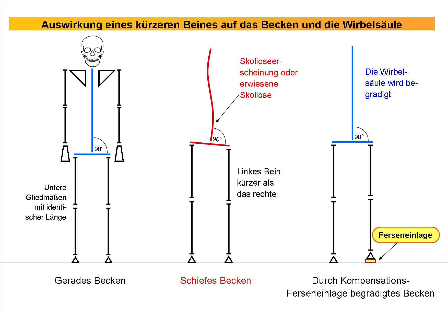 Auswirkung eines kürzeren Beines auf das Becken und die Wirbelsäule