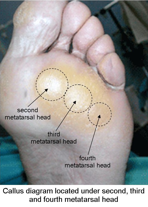 Callus diagram located under second, third and fourth metatarsal head