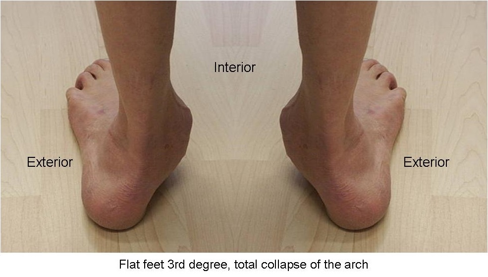 Photo flat feet 3rd degree, total collapse of the arch