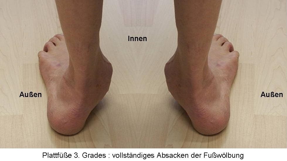 Plattfüße 3. Grades : vollständiges Absacken der Fußwölbung