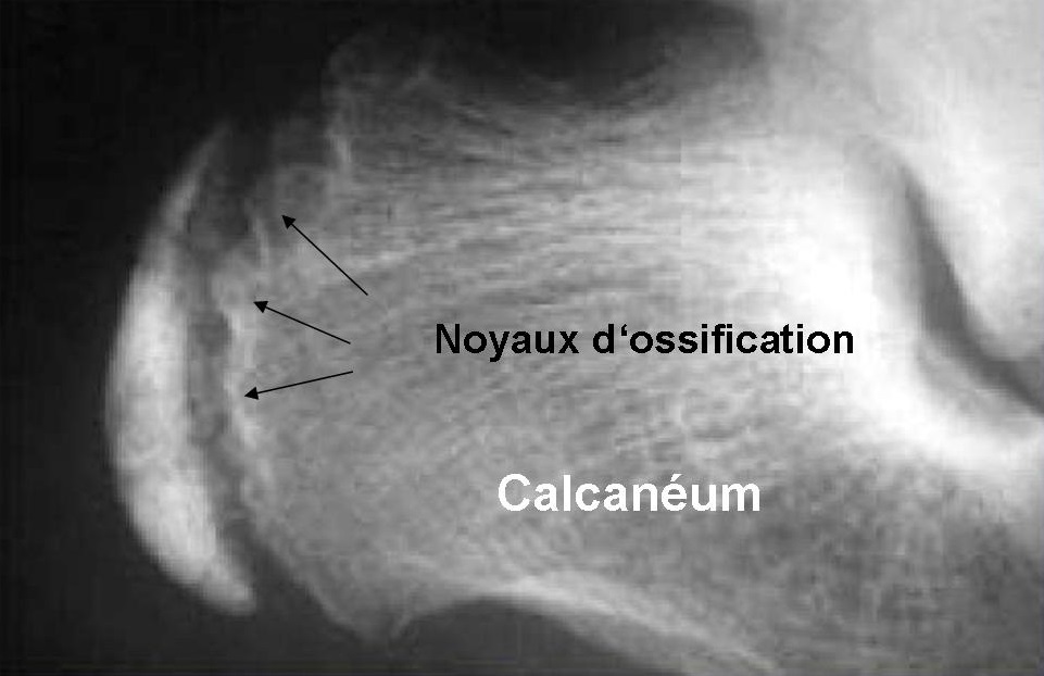 Radiographie Calcanéum Noyaux Ossification