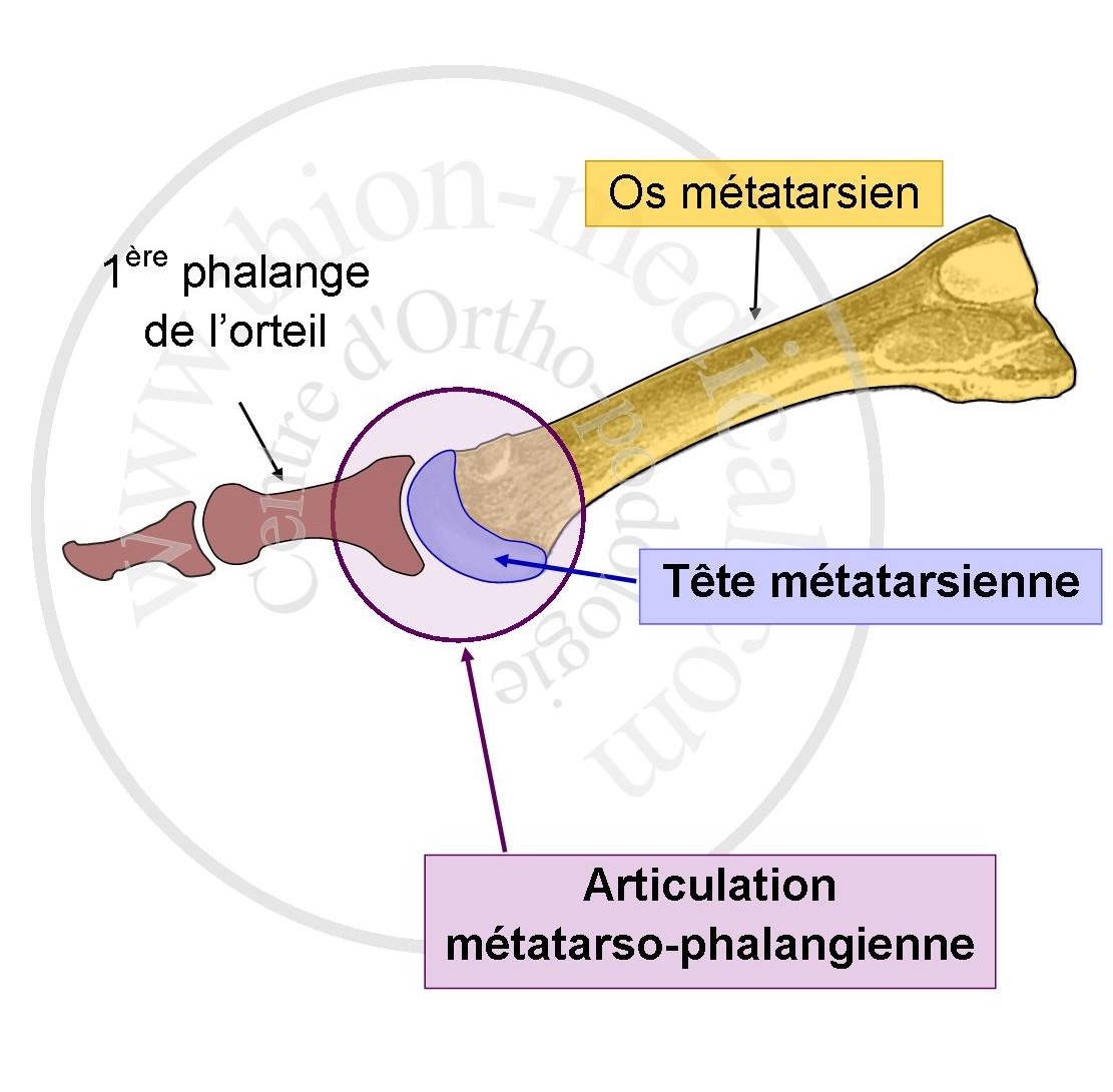 Tête métatarsienne