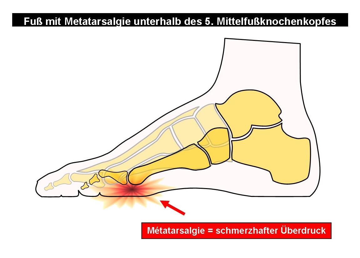 Skelettschema Fuß mit Metatarsalgien unterhalb der 5. Zehe