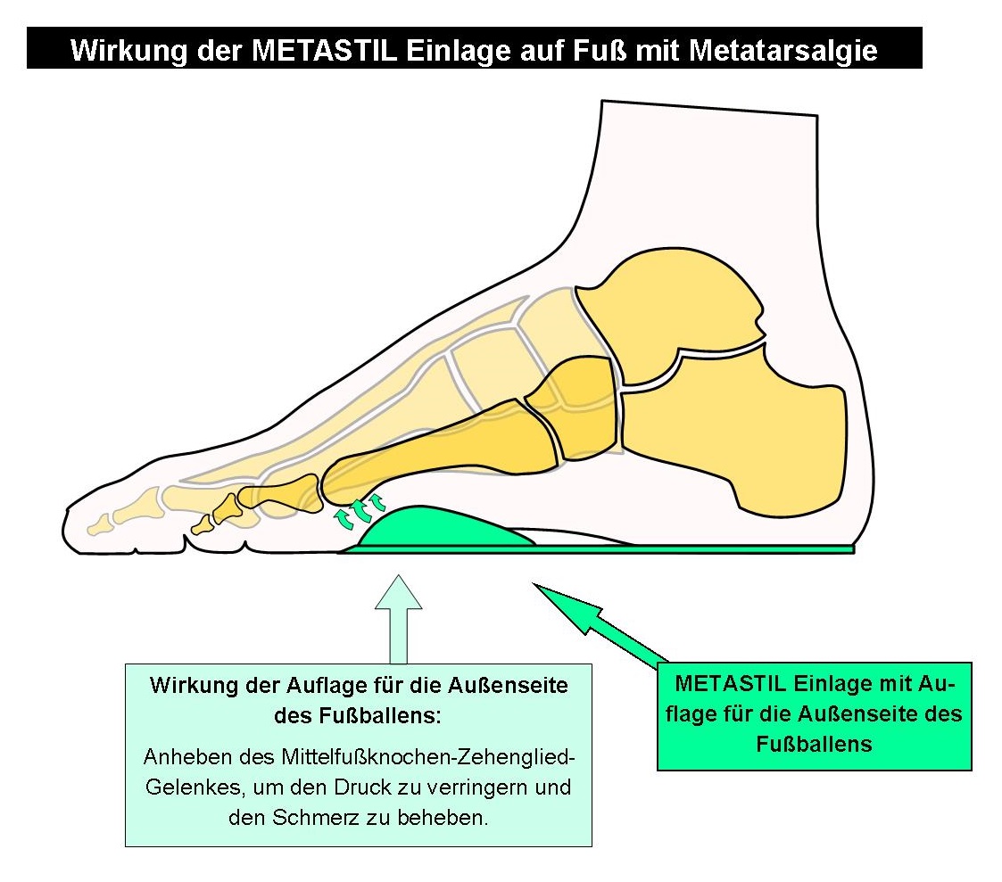 Skelettschema Fuß mit Metatarsalgien unterhalb der 5. Zehe mit METASTIL Einlage