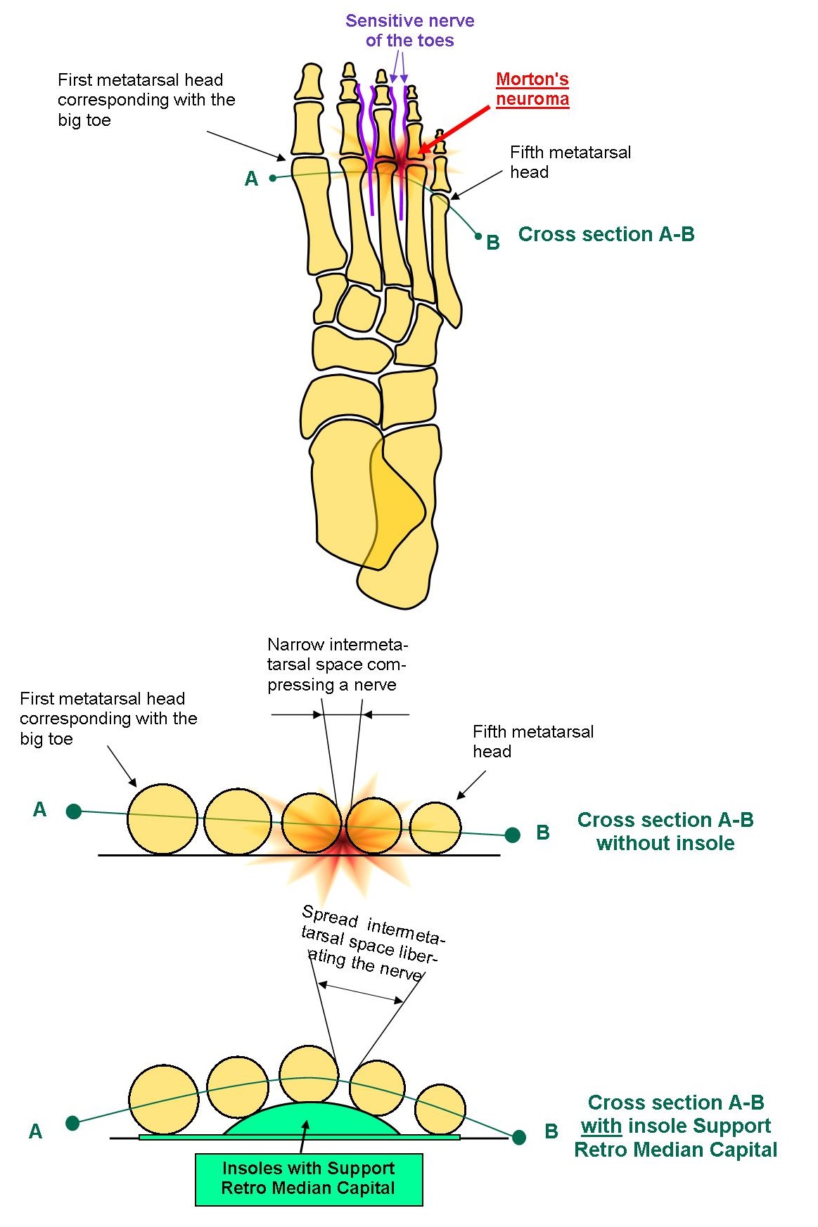 Morton’s neuroma