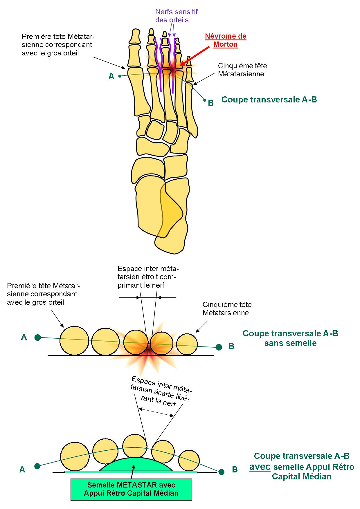 Pathologies > Maladie de Morton