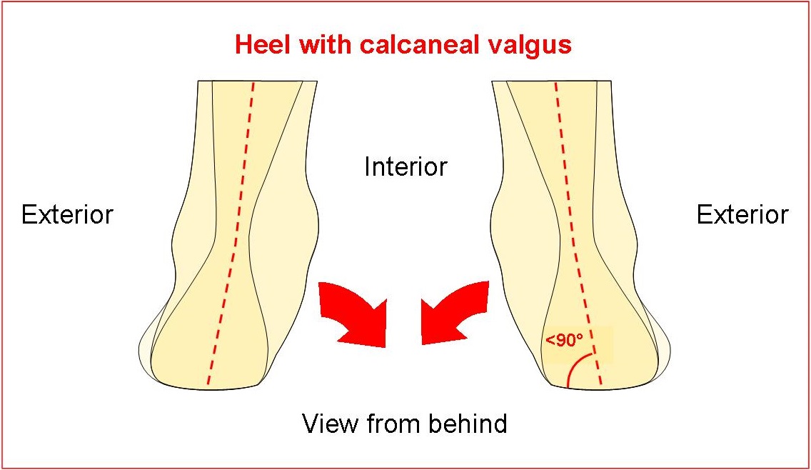 Heel with calcaneal valgus