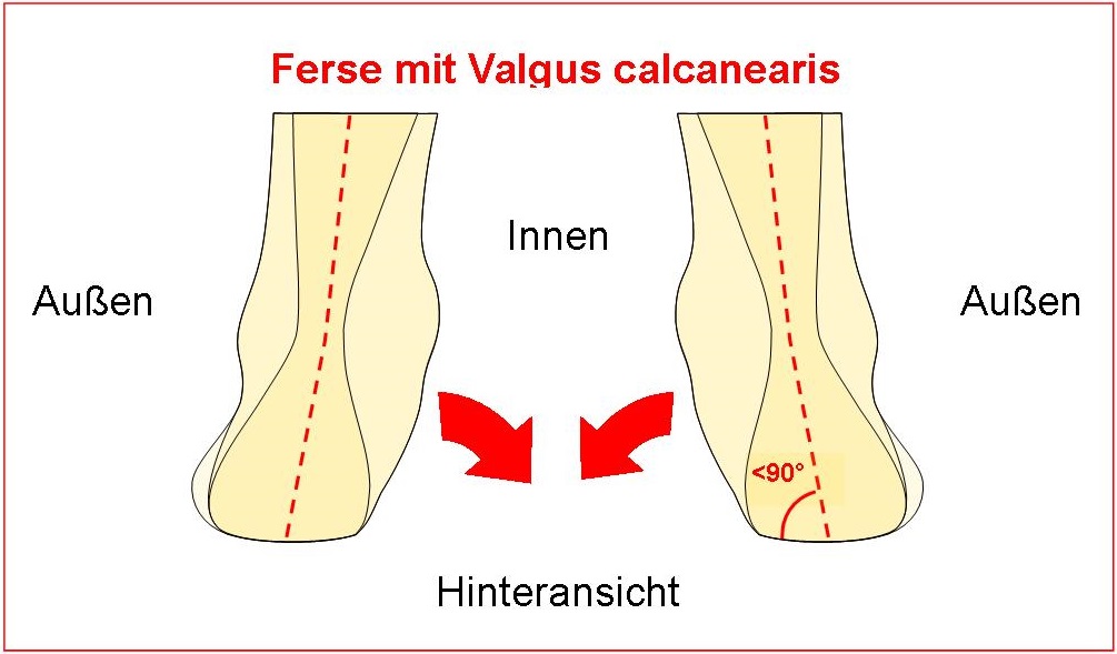 Ferse mit Valgus calcanearis