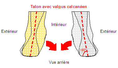 Schema Talon Valgus