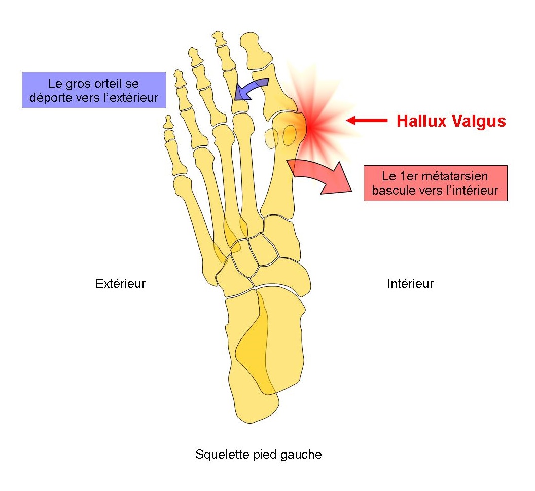 Schema squelette pied Hallux Valgus