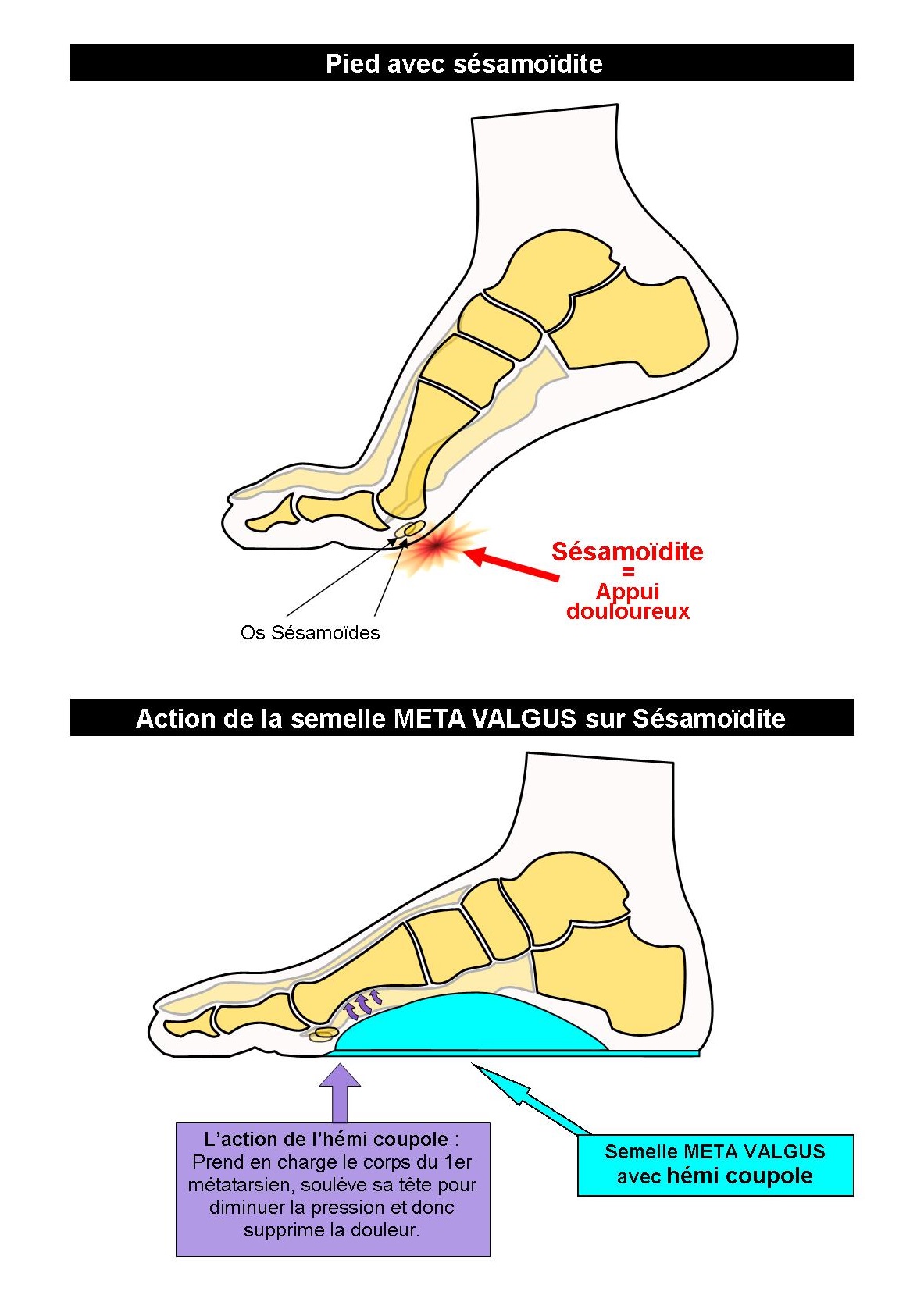 Schema squelette pied Sesamoidite