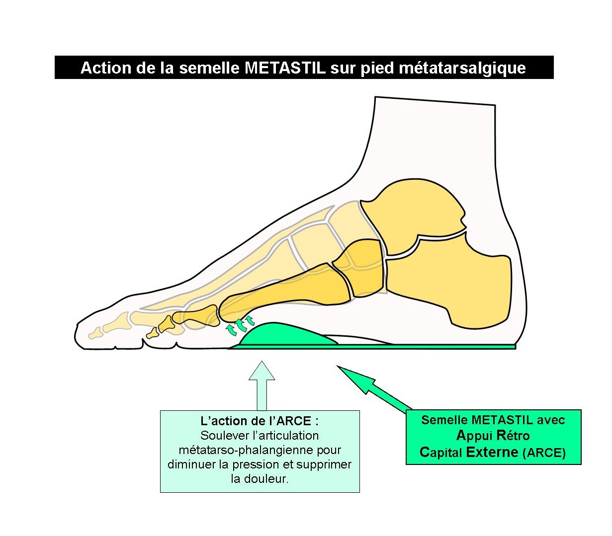 Schéma squelette pied métatarsalgique 5ème tête avec Semelle METASTIL