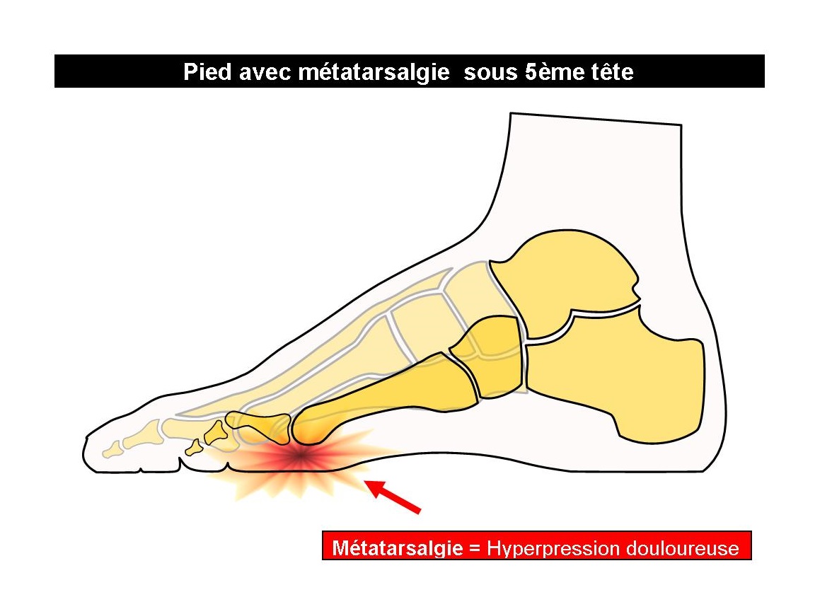 Schéma squelette pied avec métatarsalgies 5ème tête