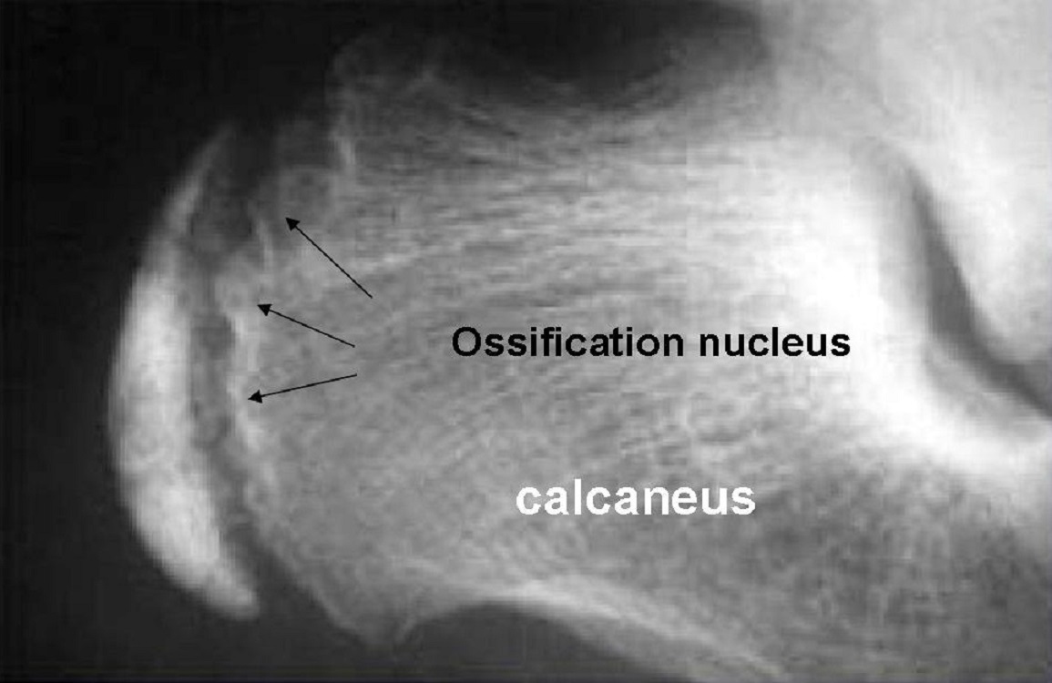 Ossification nucleus