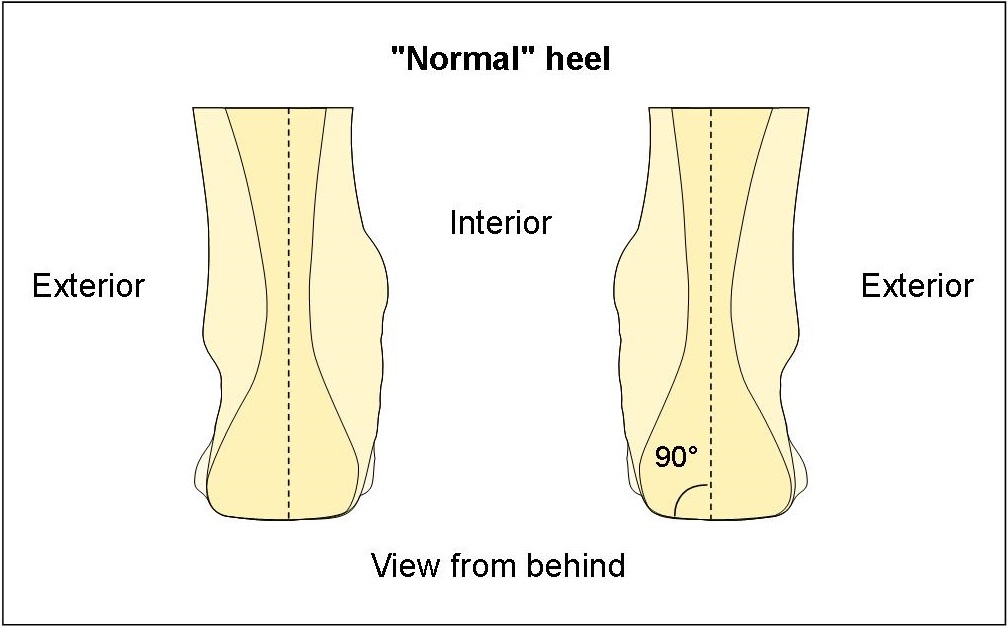 Normal heel