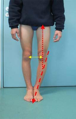 Genu Varum Ou Jambes Arquees Oxa Medical Genu Varum Ou Jambes Arquees Oxa Medical
