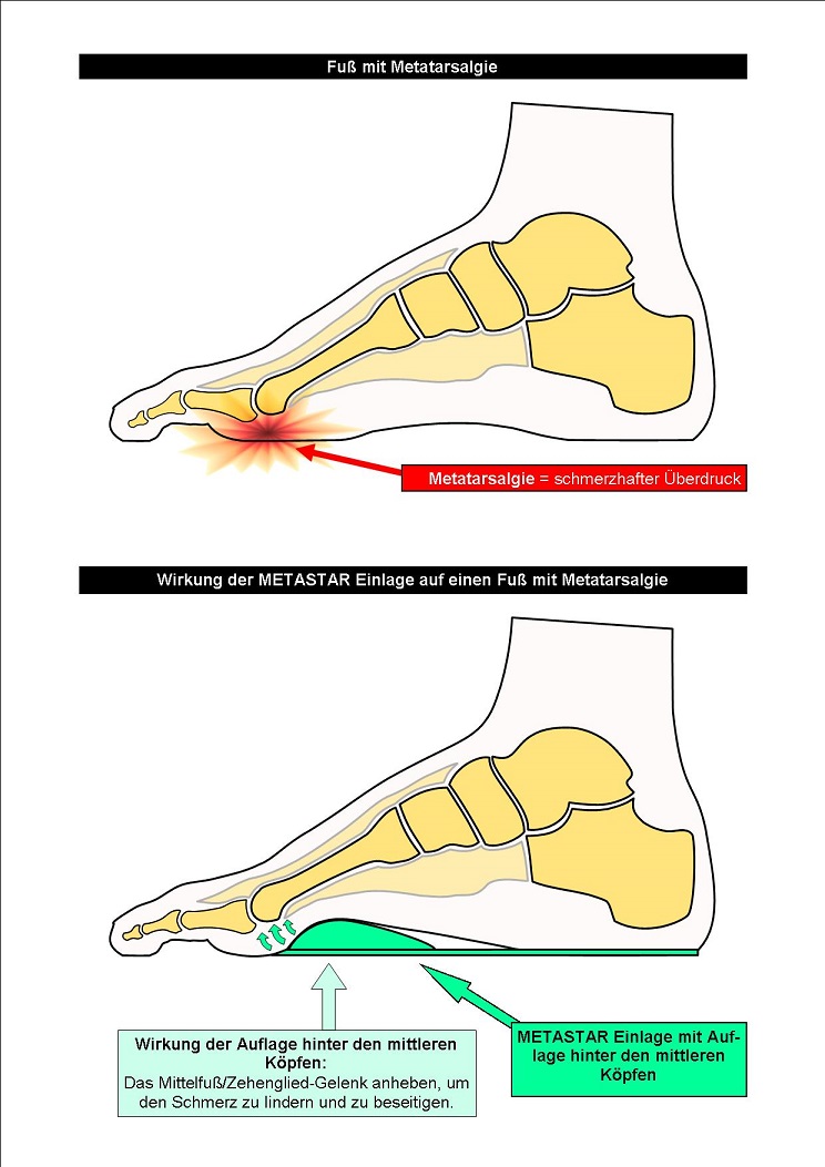Schema Wirkung der METASTAR Einlage auf einen Fuß mit Metatarsalgie