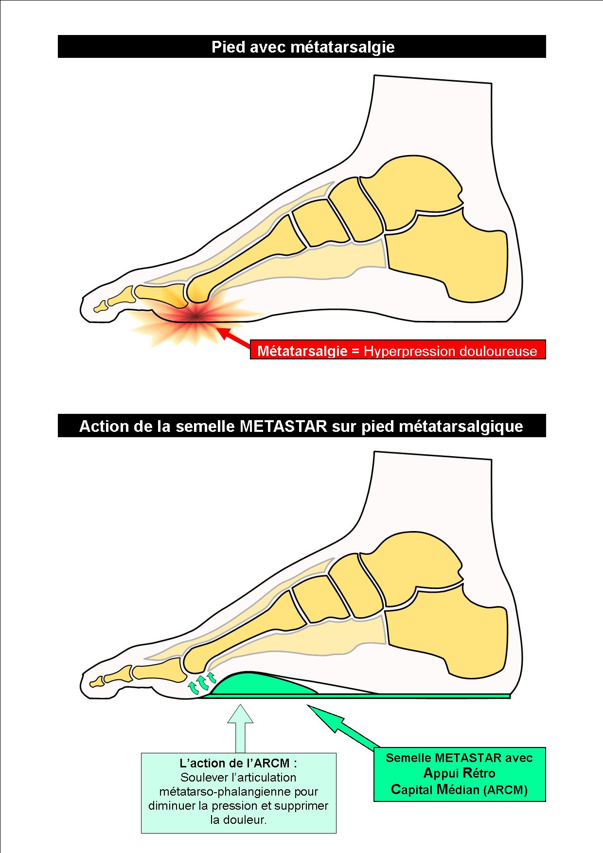 Schéma Action de la semelle METASTAR sur pied métatarsalgique