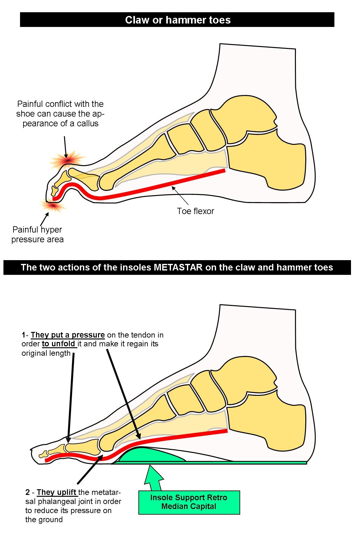 Diagram of the bone structure for the claw or hammer toes