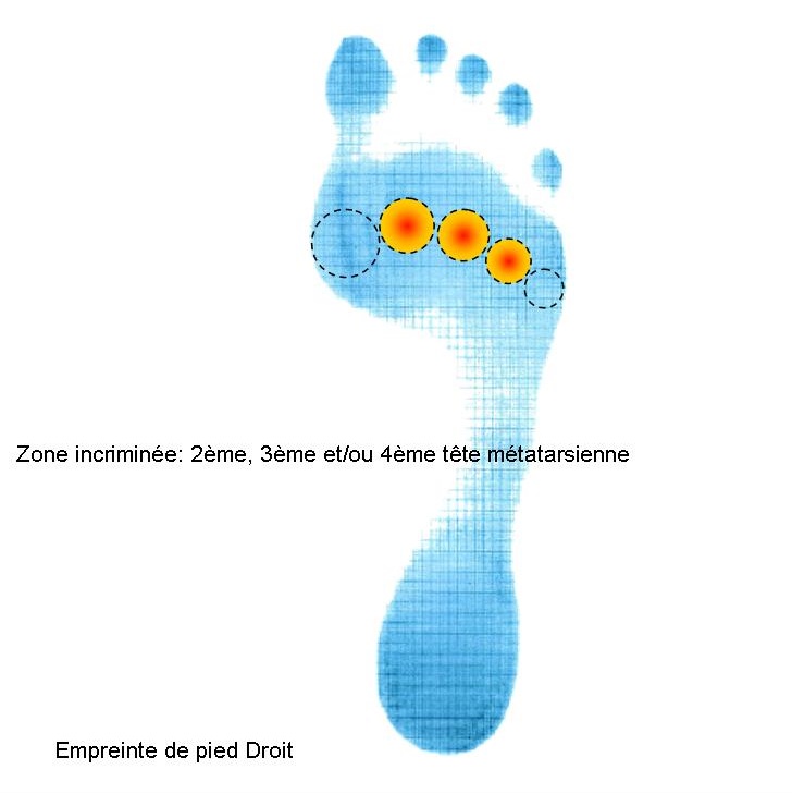 Emprinte pied avec zone douleurs sous 2, 3, 4ème têtes méta