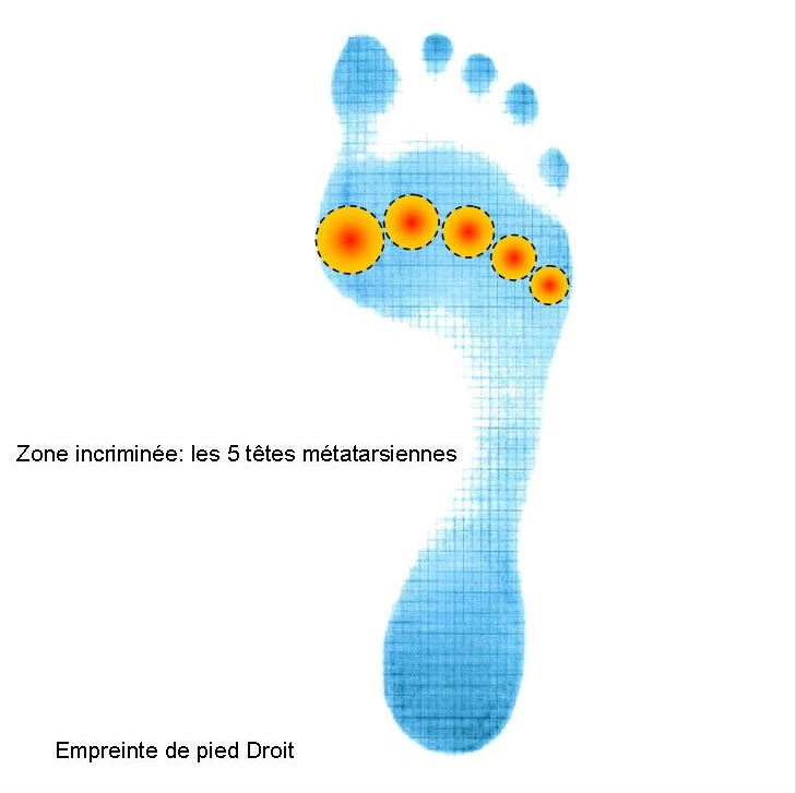 Zone de douleurs des articulations de tous les orteils