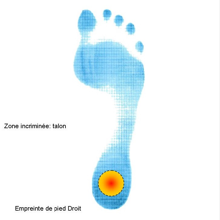 Zone des troubles biomécaniques du pied au talon