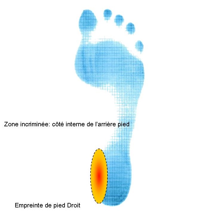 Zone du talon côté interne des troubles biomécaniques du pied