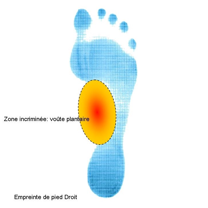 Zone médiane du pied > Zone douleurs voûte plantaire